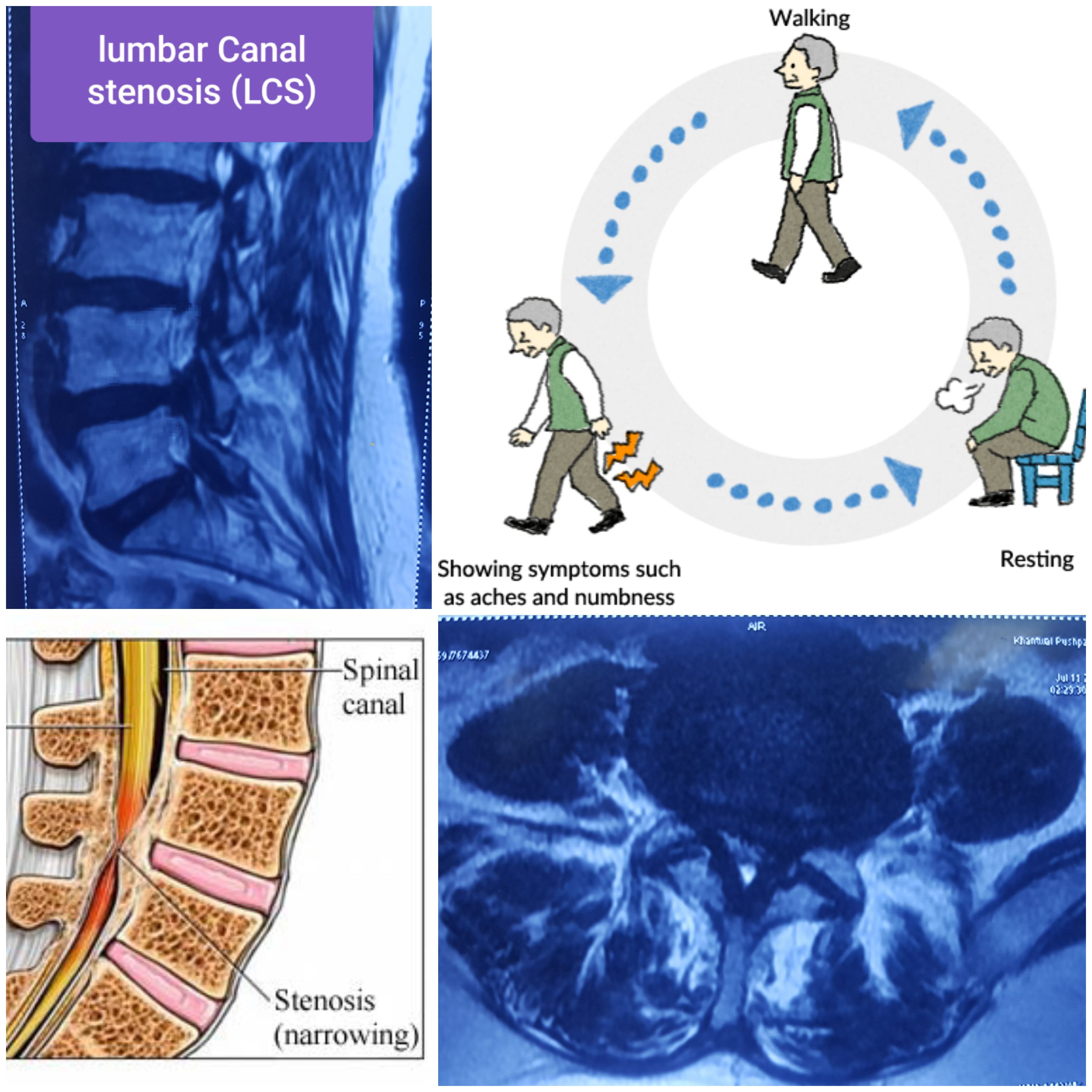 lumbar canal stenosis (2).jpg